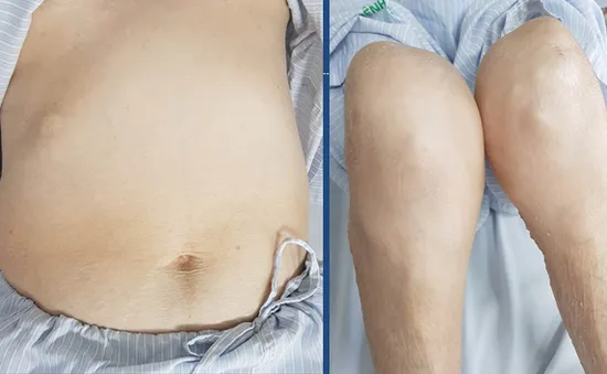 Cảnh báo hội chứng Cushing do lạm dụng thuốc corticoid