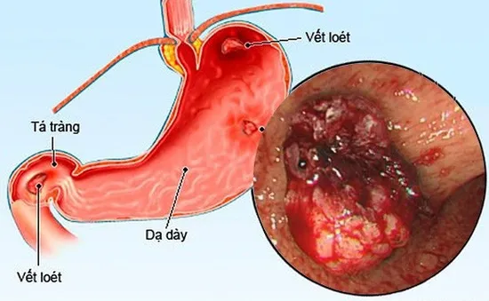 Cảnh giác với viêm loét dạ dày do vi khuẩn HP ở trẻ em