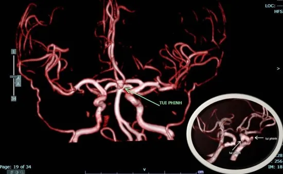 Chủ quan với cơn đau đầu, người phụ nữ bị đột quỵ chảy máu não