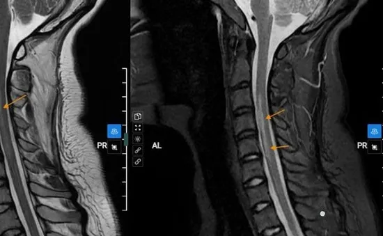 Nữ sinh 20 tuổi đột ngột bị yếu liệt tay sau khi ngủ dậy vì thói quen nhiều bạn trẻ mắc phải