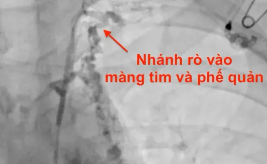 Đau ngực kèm theo khó thở, thanh niên phát hiện viêm phế quản "nhựa" hiếm gặp