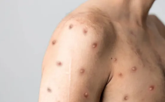 WHO họp khẩn về sự lây lan của bệnh đậu mùa khỉ