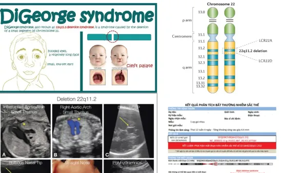 Bệnh DiGeorge được khuyến cáo sàng lọc cho thai phụ