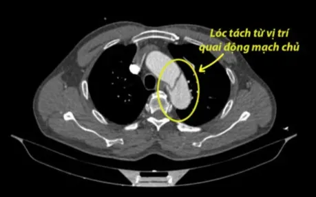 Kịp thời cứu người đàn ông bị lóc tách động mạch chủ ngực