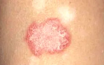 Điều trị thành công cho 2 bệnh nhân bị lupus ban đỏ hệ thống