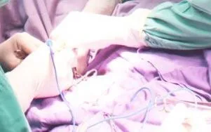 Đi khám vì đau bụng, bác sĩ phát hiện ruột thừa viêm do vi khuẩn lao