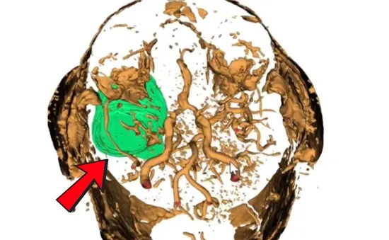 Vi phẫu khối u màng não kích thước lớn vùng nền sọ cho bệnh nhân