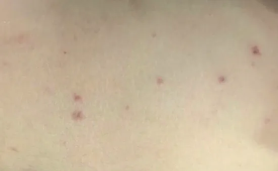 Yên Bái: Một trường hợp dương tính với vi khuẩn não mô cầu