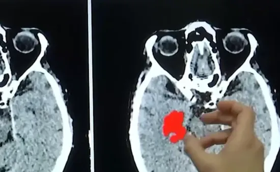 Mối liên hệ bí ẩn giữa vi nhựa với nguy cơ đau tim và đột quỵ.