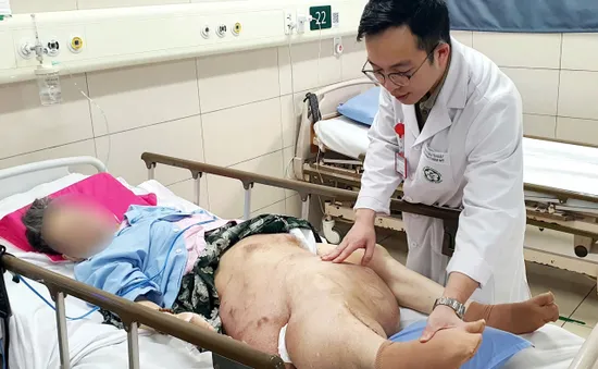 U xơ thần kinh gây biến dạng chân: Cảnh báo từ ca bệnh bỏ điều trị giữa chừng
