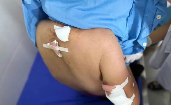 Cụ bà 77 tuổi bị đàn chó cắn, nhiều vết thương khắp cơ thể