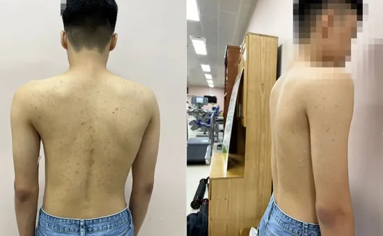 Khám miễn phí gù, vẹo cột sống cho trẻ dưới 18 tuổi