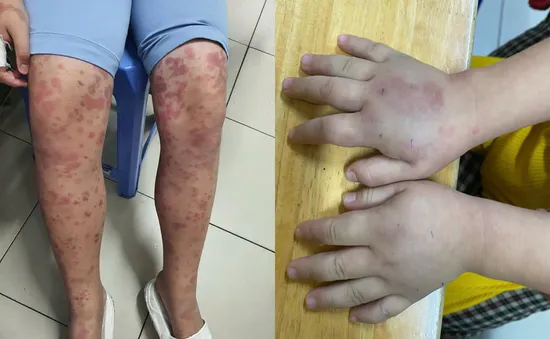 Cẩn trọng với ban xuất huyết Schonlein- Henoch ở trẻ