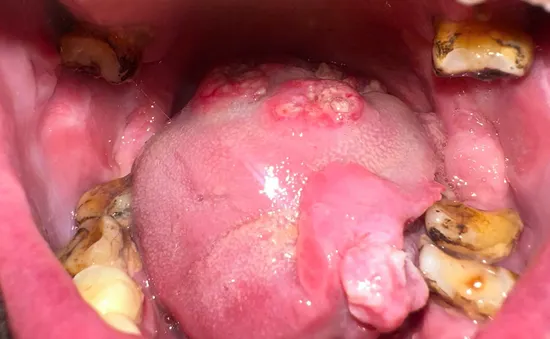 Ung thư khoang miệng: Các biểu hiện ban đầu thường gặp