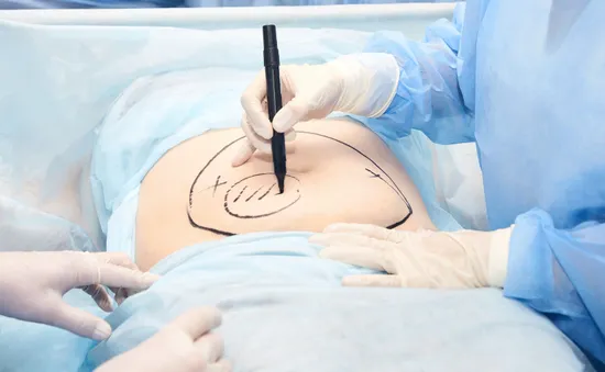 Yêu cầu Bệnh viện Đa khoa Gia Định tạm ngưng phẫu thuật hút mỡ bụng