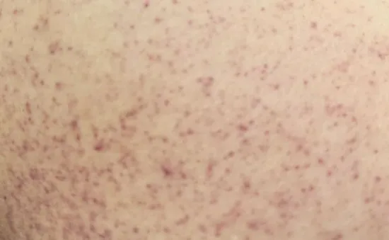 Cô gái 21 tuổi suýt mất mạng vì sốc sốt xuất huyết Dengue nặng