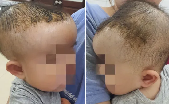 Bé 7 tháng tuổi bị tụ máu đầu do ngã giường