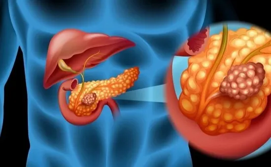 Phát hiện ung thư tụy giai đoạn cuối từ biểu hiện đau bụng kéo dài