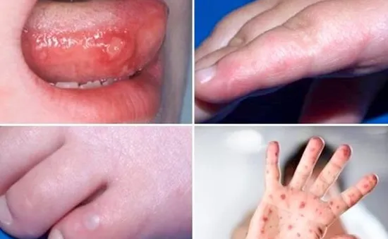 TP Hồ Chí Minh: Số ca mắc bệnh tay chân miệng tiếp tục tăng