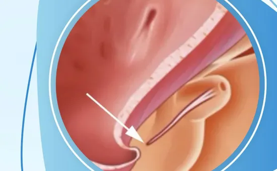 Lỗ tiểu thấp ở trẻ em: 5 dấu hiệu cha mẹ không nên bỏ qua