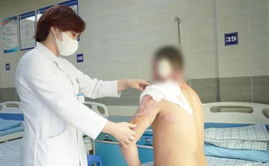 Bất cẩn để ngọn lửa bén vào xăng gây bỏng nặng vùng mặt