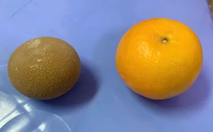 Lấy sỏi bàng quang to như quả cam khỏi cơ thể người đàn ông 69 tuổi