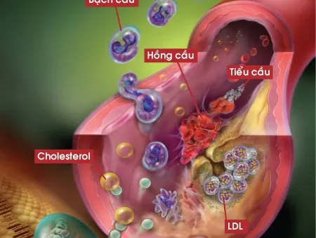 Lưu ý cho bệnh nhân rối loạn mỡ máu