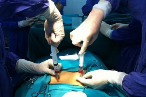 Phương pháp chữa liệt thành công bằng tế bào gốc