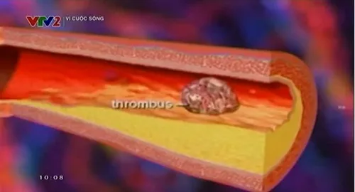 Những biến chứng nguy hiểm của bệnh động mạch vành