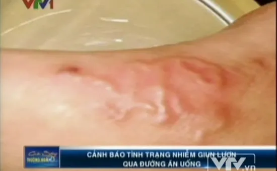 Cảnh báo bệnh nguy hiểm: Giun lươn bò dưới da 
