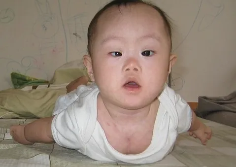 Nguy hiểm bệnh lý nhược cơ