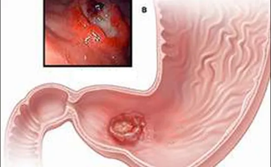 Diệt vi khuẩn H. Pylory - Thuốc gì?