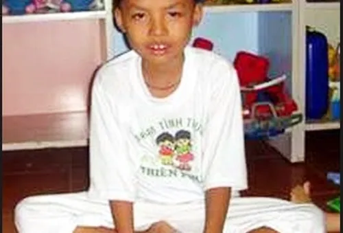 Lưu ý chăm sóc trẻ bị loạn dưỡng cơ Duchenne