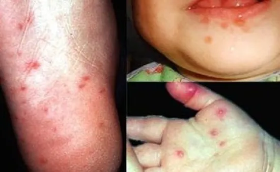 Gần 8.000 ca mắc tay chân miệng trên cả nước