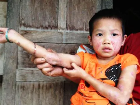 Bé 7 tuổi mất ăn, mất ngủ vì căn bệnh "lạ"