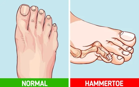 thoái hóa khớp gối: Tin tức, Video, hình ảnh thoái hóa khớp gối
