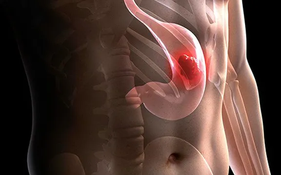 Những dấu hiệu "&acirc;m thầm" kh&ocirc;ng g&acirc;y đau đớn của bệnh ung thư dạ d&agrave;y