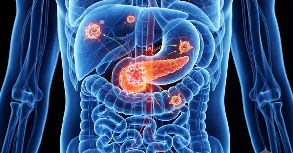 Mỹ phê duyệt thuốc điều trị ung thư tuyến tụy di căn