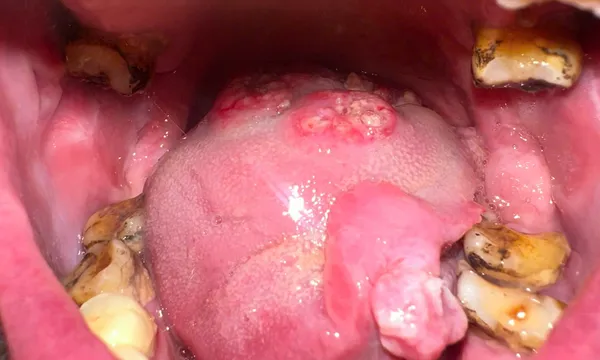 Loét miệng kéo dài - đừng chủ quan, có thể là ung thư khoang miệng