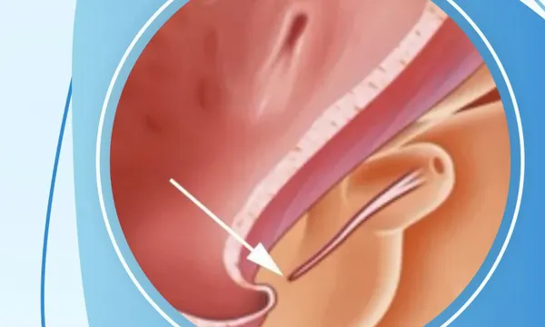 Lỗ tiểu thấp ở trẻ em: 5 dấu hiệu cha mẹ không nên bỏ qua