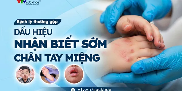 Dấu hiệu nhận niết bệnh Tay Chân Miệng – Ba mẹ cần biết!