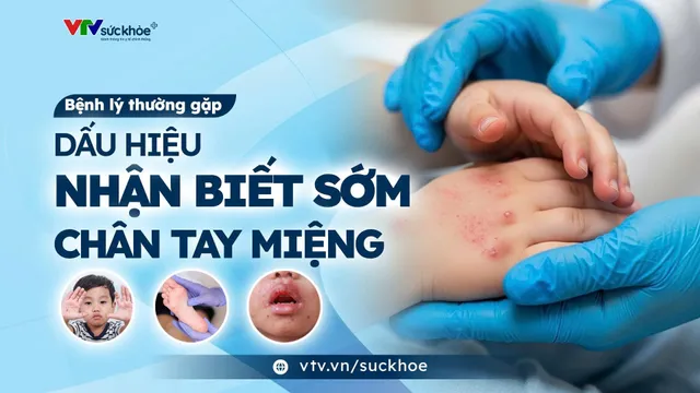 Dấu hiệu nhận niết bệnh Tay Chân Miệng – Ba mẹ cần biết!