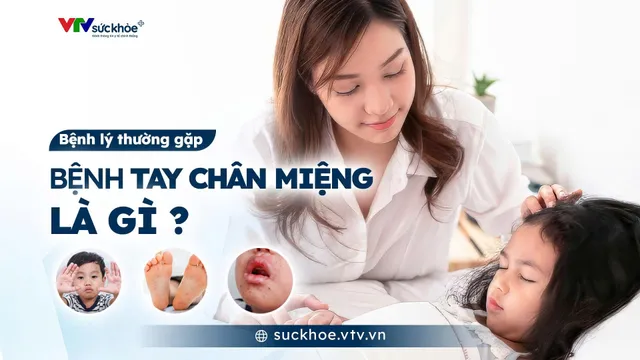 Bệnh Tay Chân Miệng là gì?