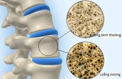 Loãng xương, thoái hóa khớp không còn là 'bệnh của người già'