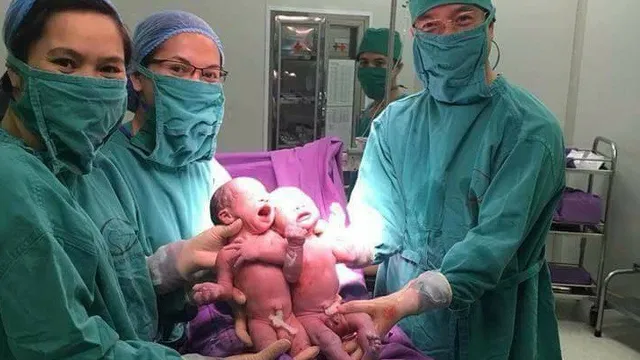 Quảng Ninh: Hai bé sinh đôi cùng trứng đầu tiên nhờ thụ tinh ống nghiệm IVF
