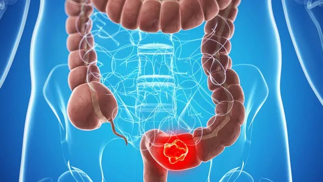 5 hiểu lầm tai hại về ung thư đại trực tràng
