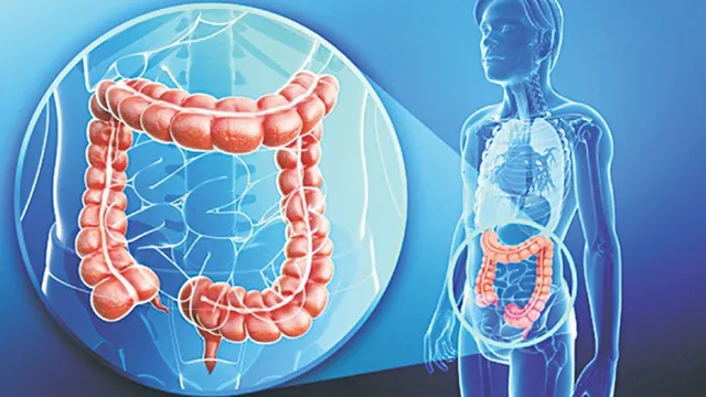 Viêm loét đại tràng có thể tăng nguy cơ ung thư đại trực tràng?