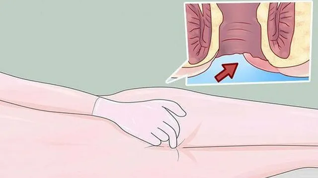 Đừng nhầm bệnh trĩ với ung thư hậu môn