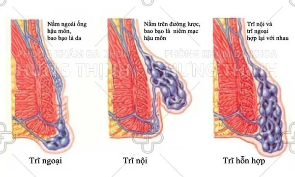 Triệu chứng và cách phòng, điều trị bệnh trĩ