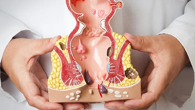 Cách phát hiện sớm ung thư hậu môn